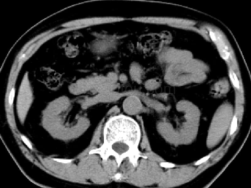 肾脏及肾上腺的CT_第4页