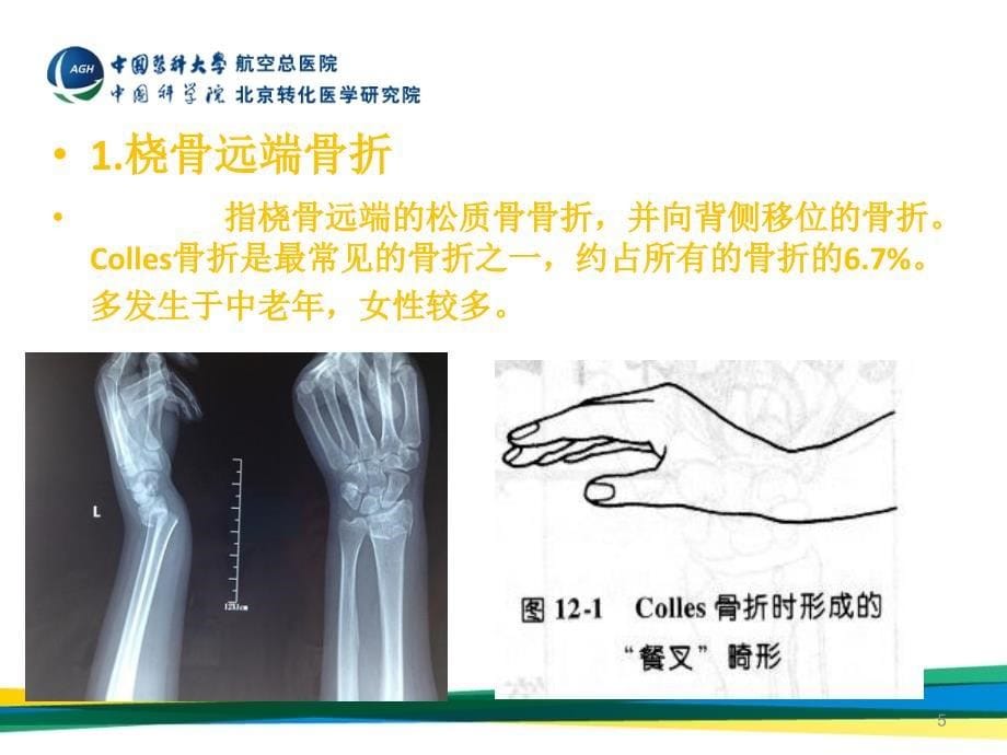 桡骨骨折资料_第5页