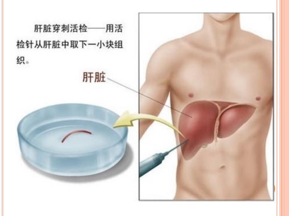 肝穿刺的意义与安全性_第3页