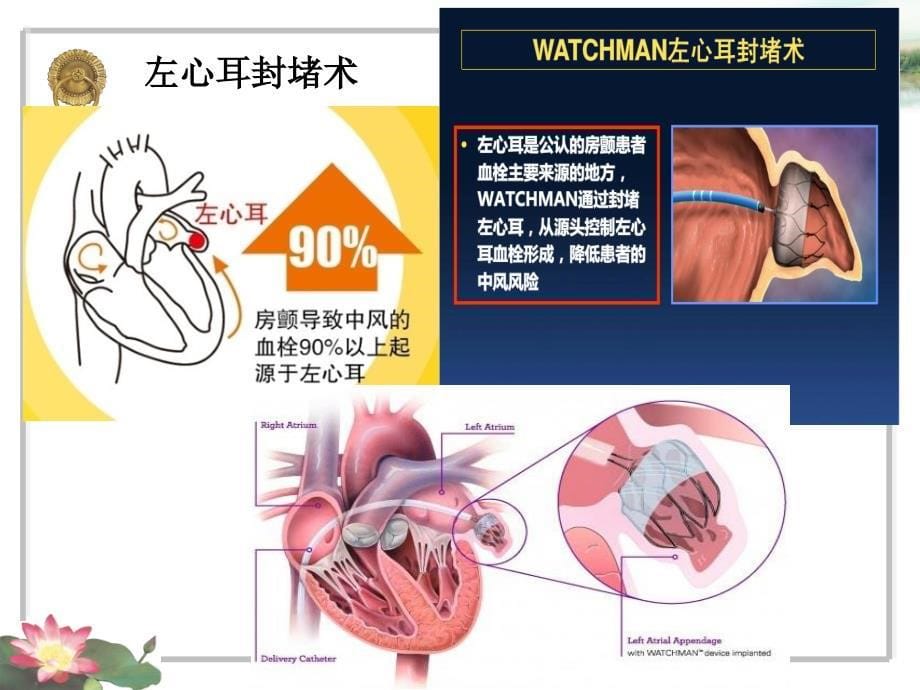 浅谈左心耳封堵术_第5页