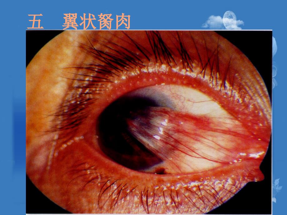 翼状胬肉及干眼症、眼外伤等_第1页