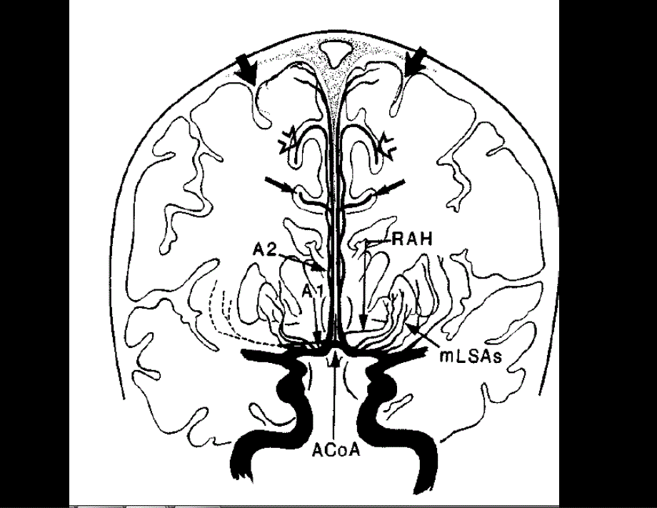 前交通动脉瘤解剖与临床_第3页