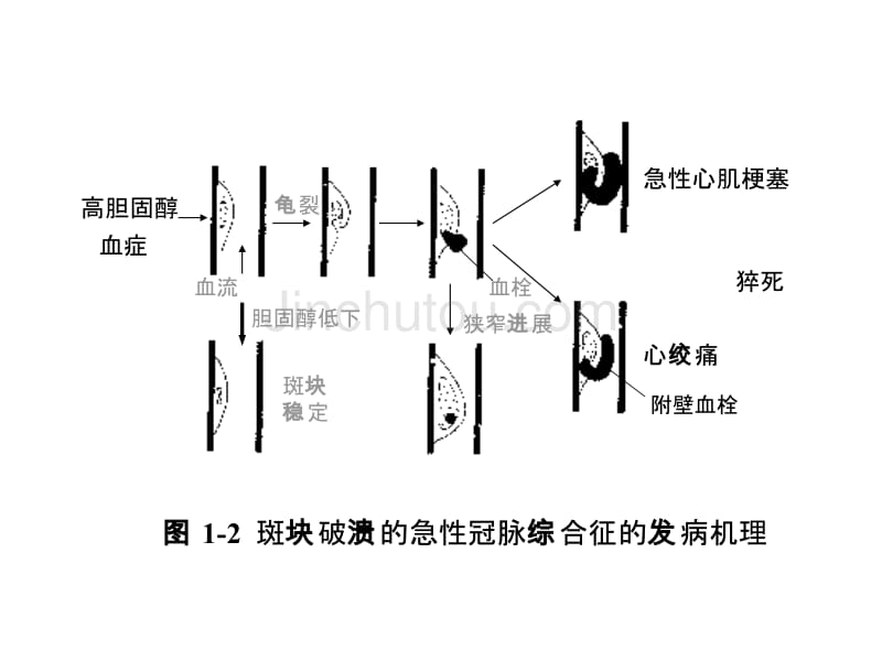 AMI早期诊断与防治_第4页