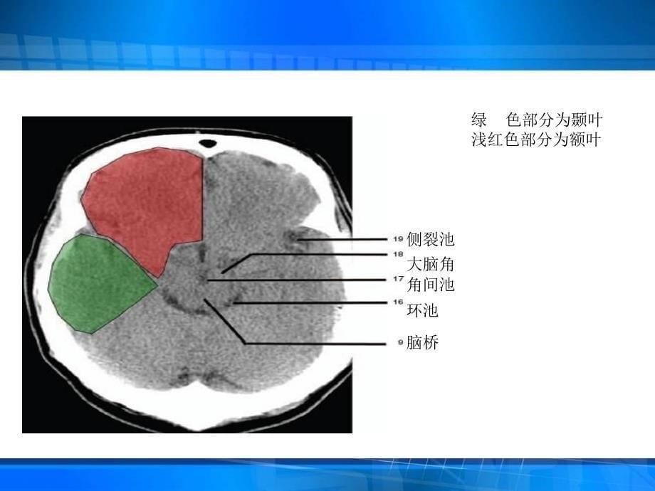 教你看ct(颅脑)_第5页