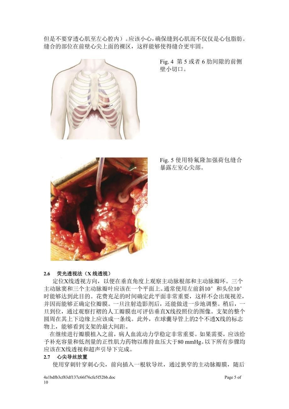 经心尖主动脉瓣膜植入术的基础知识_第5页