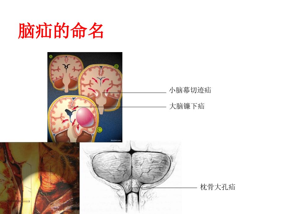 脑疝病人的护理_第4页