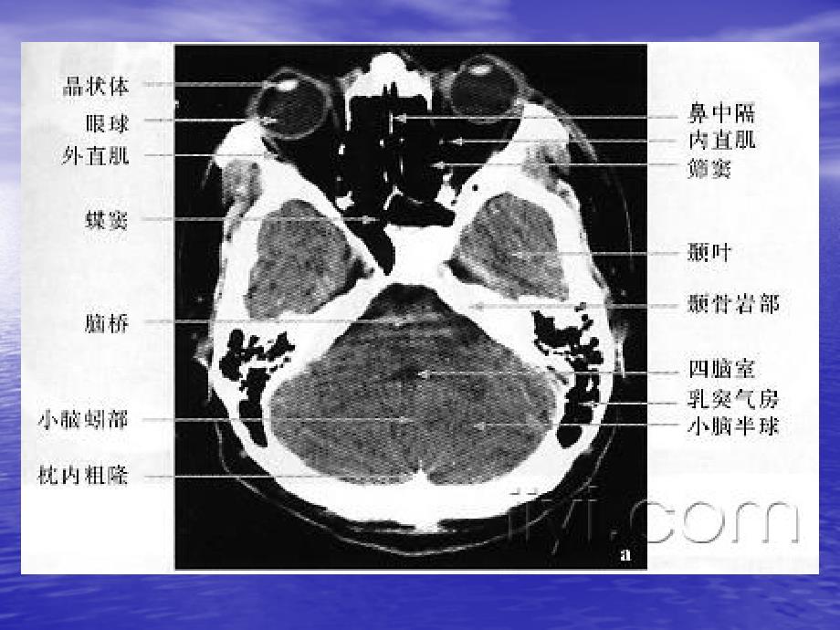 头颅ctmri影像_第1页