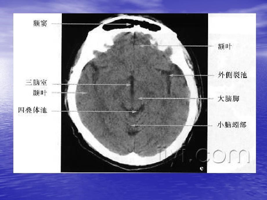 头颅ctmri影像_第5页