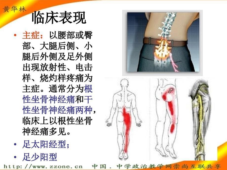 坐骨痿证痛风_第5页