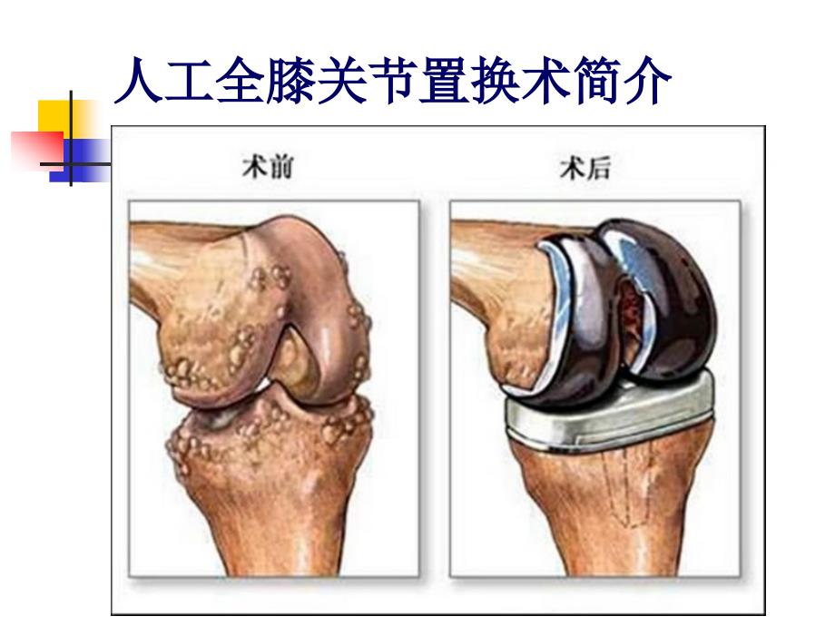 人工全膝关节置换术术前术后护理_第2页