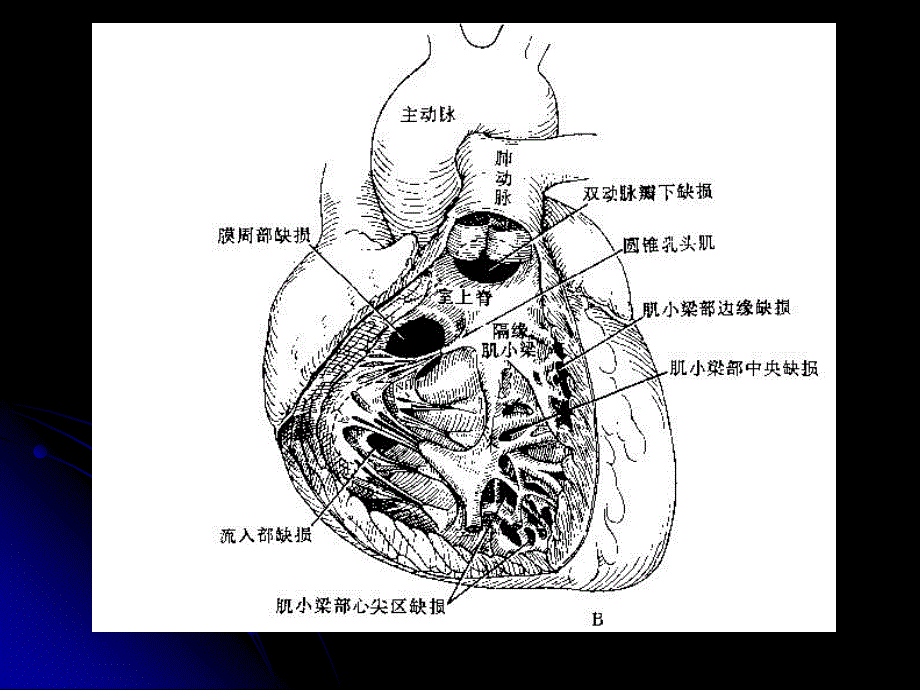 常见先天性心脏病的诊治_第3页