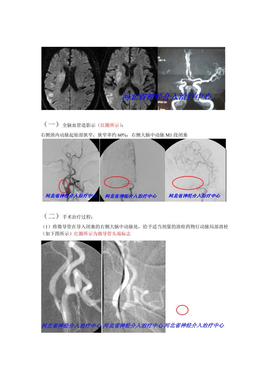 脑动脉瘤+神经介入治疗_第3页