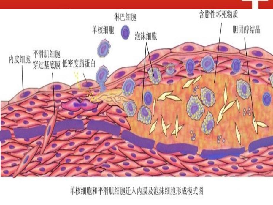 动脉粥样硬化（atherosclerosis）_第3页