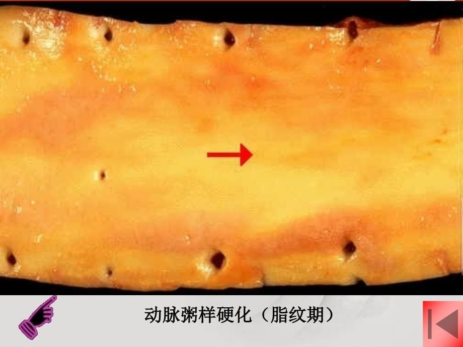 动脉粥样硬化（atherosclerosis）_第5页