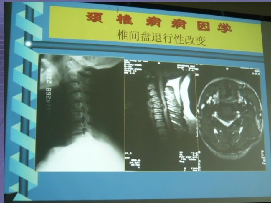 [临床医学]颈椎病的诊断与治疗_第4页