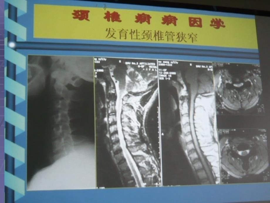 [临床医学]颈椎病的诊断与治疗_第5页