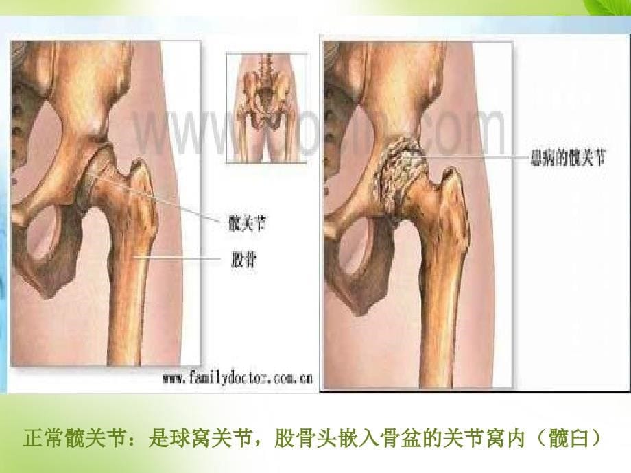 2016全髋关节置换术护理查房_第5页