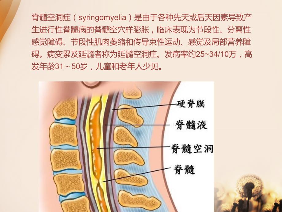 脊髓空洞症病_第2页