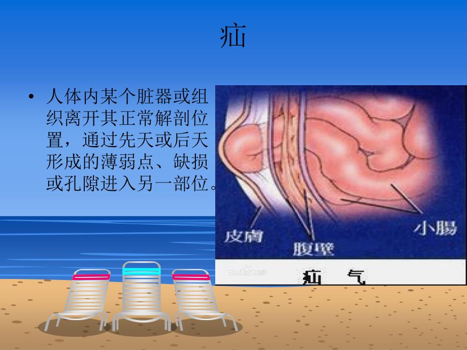 一例斜疝修补术的小讲座_第3页