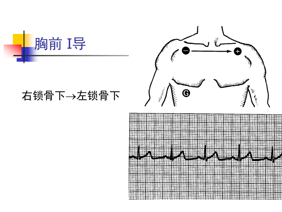 围术期心律失常的诊疗_第3页