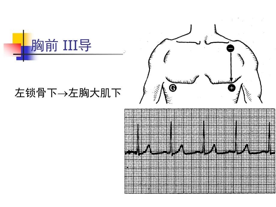 围术期心律失常的诊疗_第5页