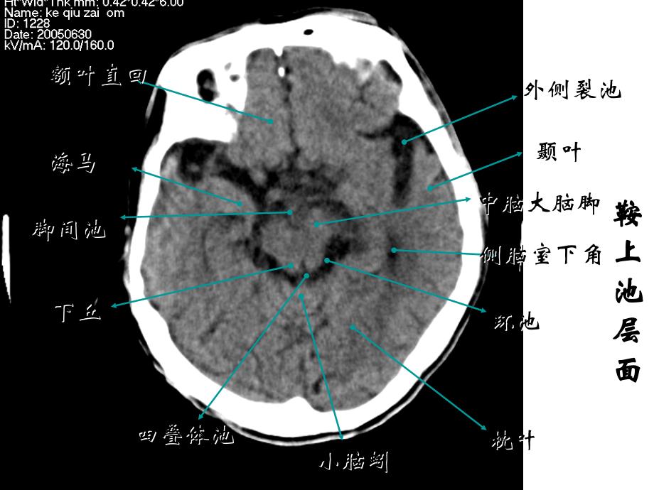 颅脑常见疾病CT诊断_第4页