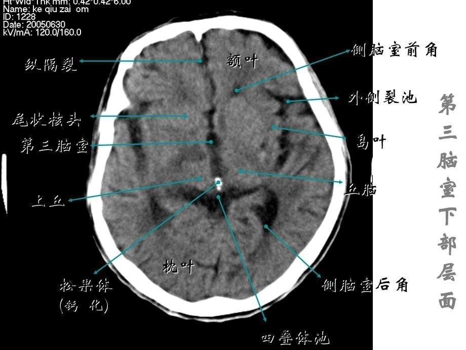 颅脑常见疾病CT诊断_第5页