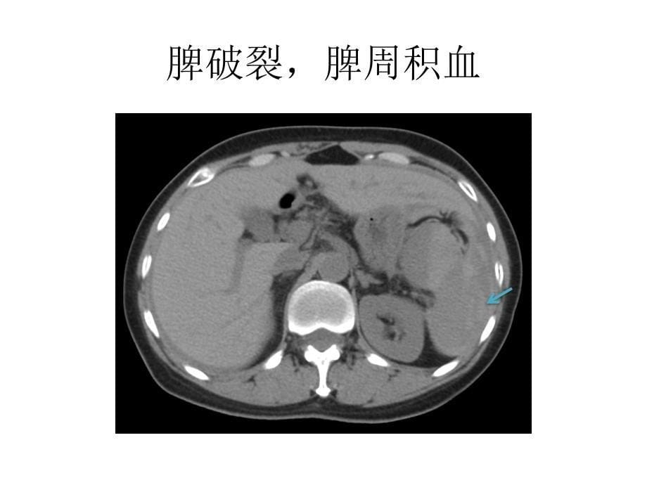 腹部实质性脏器外伤的CT表现_第5页