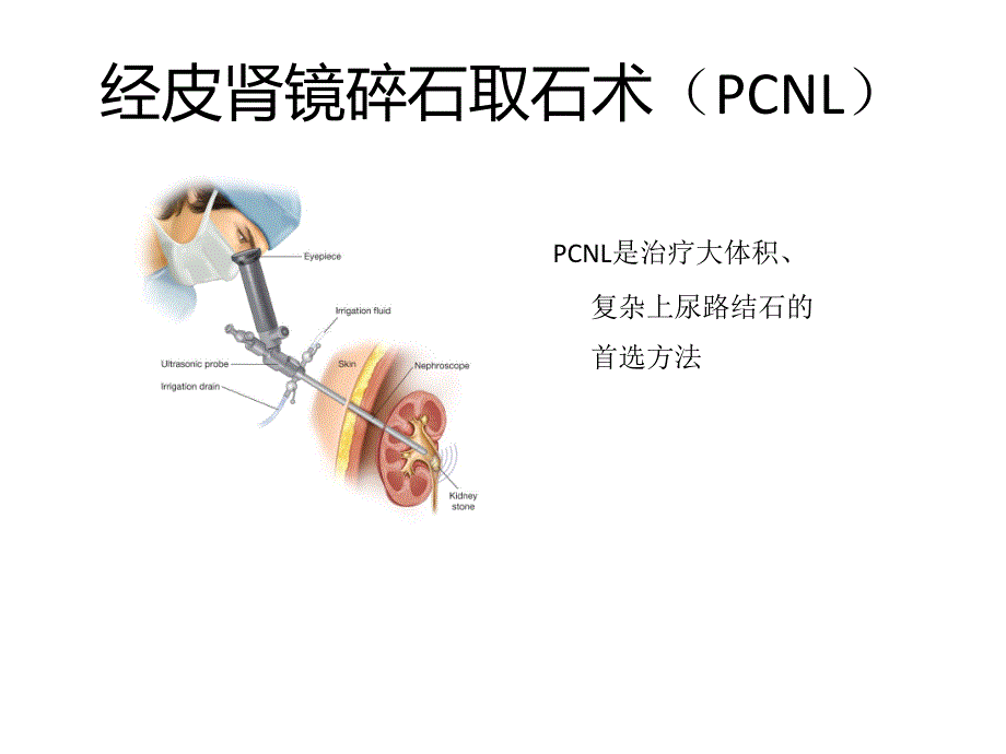 椎旁阻滞麻醉下经皮肾镜碎石术_第2页