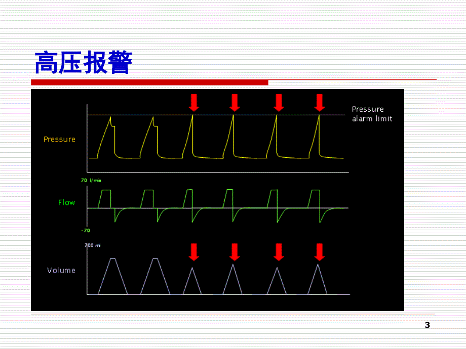 有创通气常见临床问题的处理_第3页