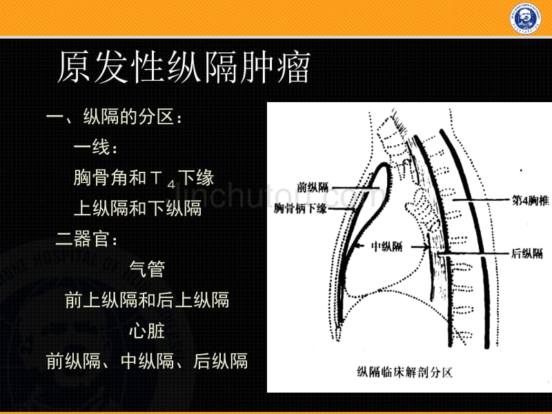 纵隔疾病改模板_第2页