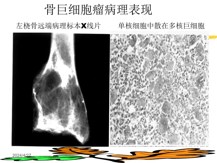 骨巨细胞瘤讲座_第4页