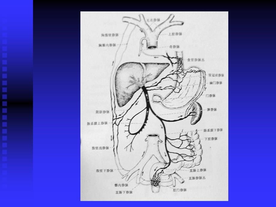 门静脉高压症的介入治疗_第5页