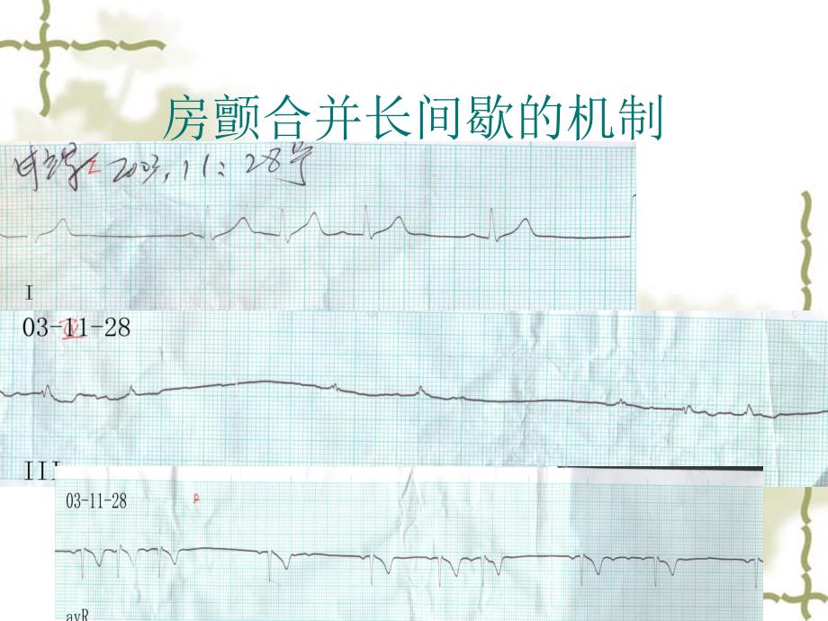 房颤与长间歇_第4页