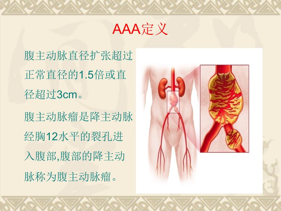 腹主动脉瘤之介入治疗_第4页