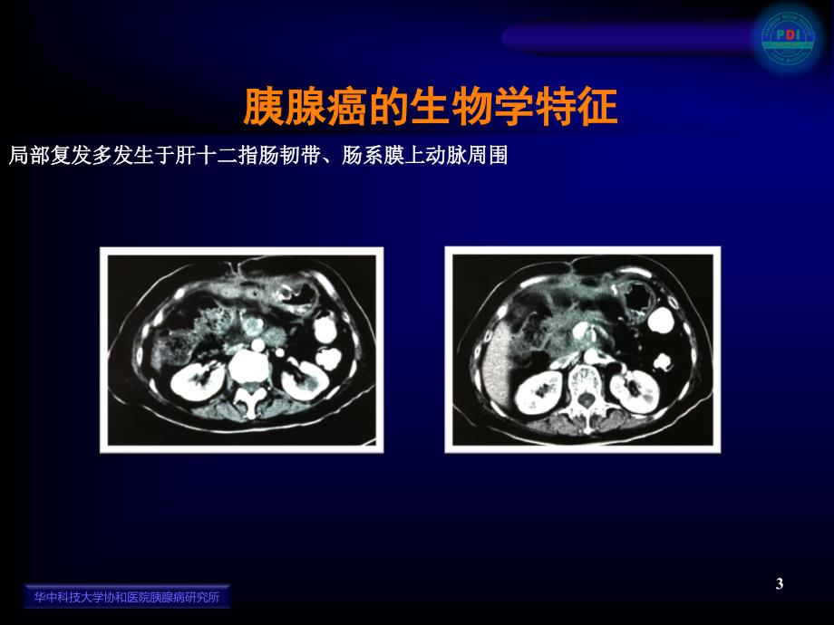 解剖性胰十二指肠切除术(中文)_第3页