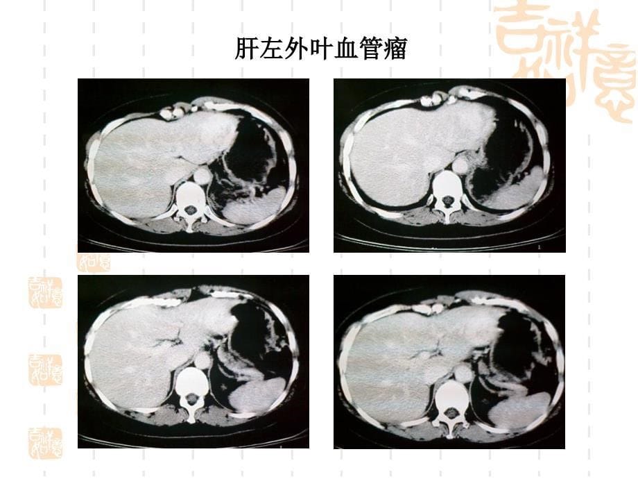 腹腔镜下左肝外叶血管瘤切除术_第5页