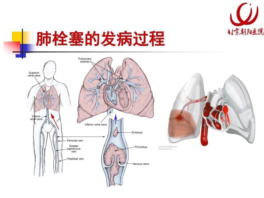 [临床医学]10-07-23-肺栓塞的诊治预防ICU护士培训班_第5页