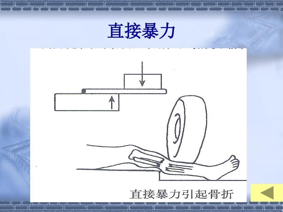 骨折病人的护理课件_第5页