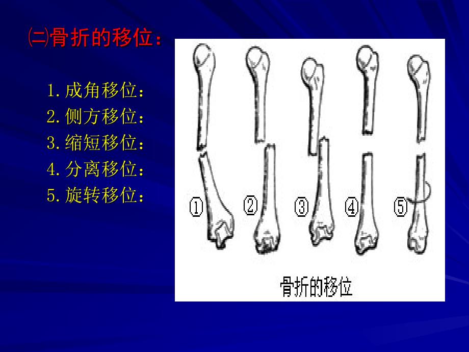 骨折的定义、临床表现、分型、愈合标准及治疗_第4页