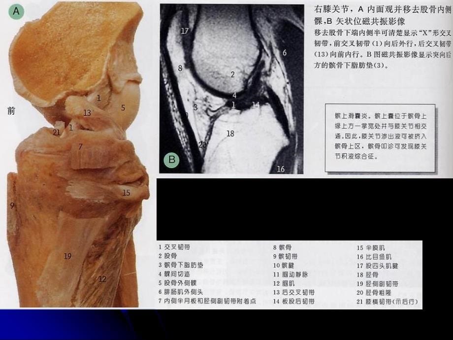 膝关节解剖及MRI诊断_第5页