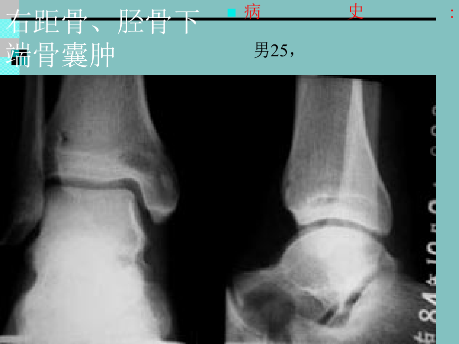 医学影像-骨肿瘤x线病例图谱_第2页