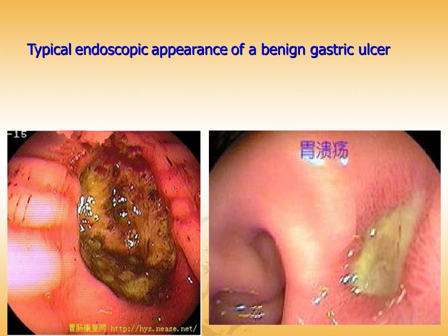 专业英语胃溃疡_第3页