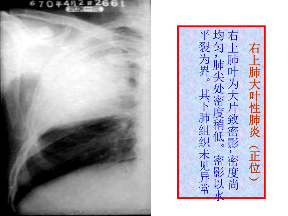 执业医师技能考试X线诊断_第4页