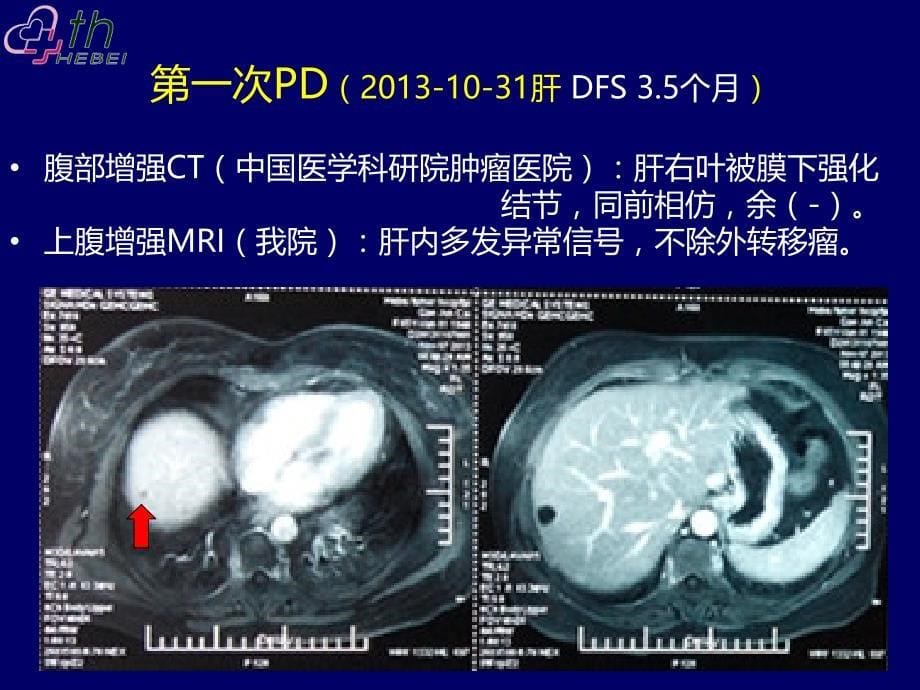 结肠癌典型病例讨论一例_第5页