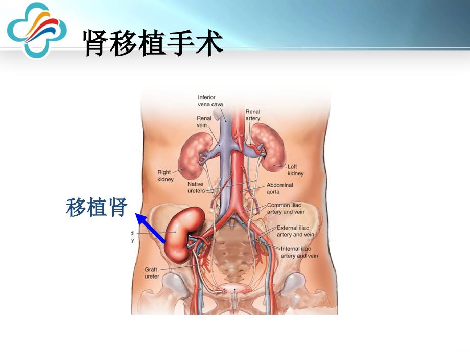 肾移植围手术管理_第3页