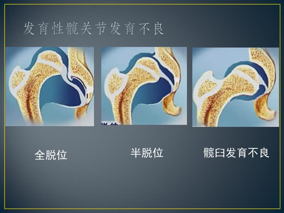 髋关节外科脱位技术与临床应用_第4页