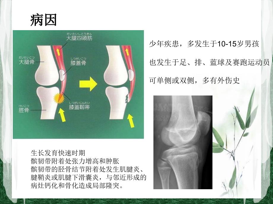 胫骨结节骨软骨炎_第3页