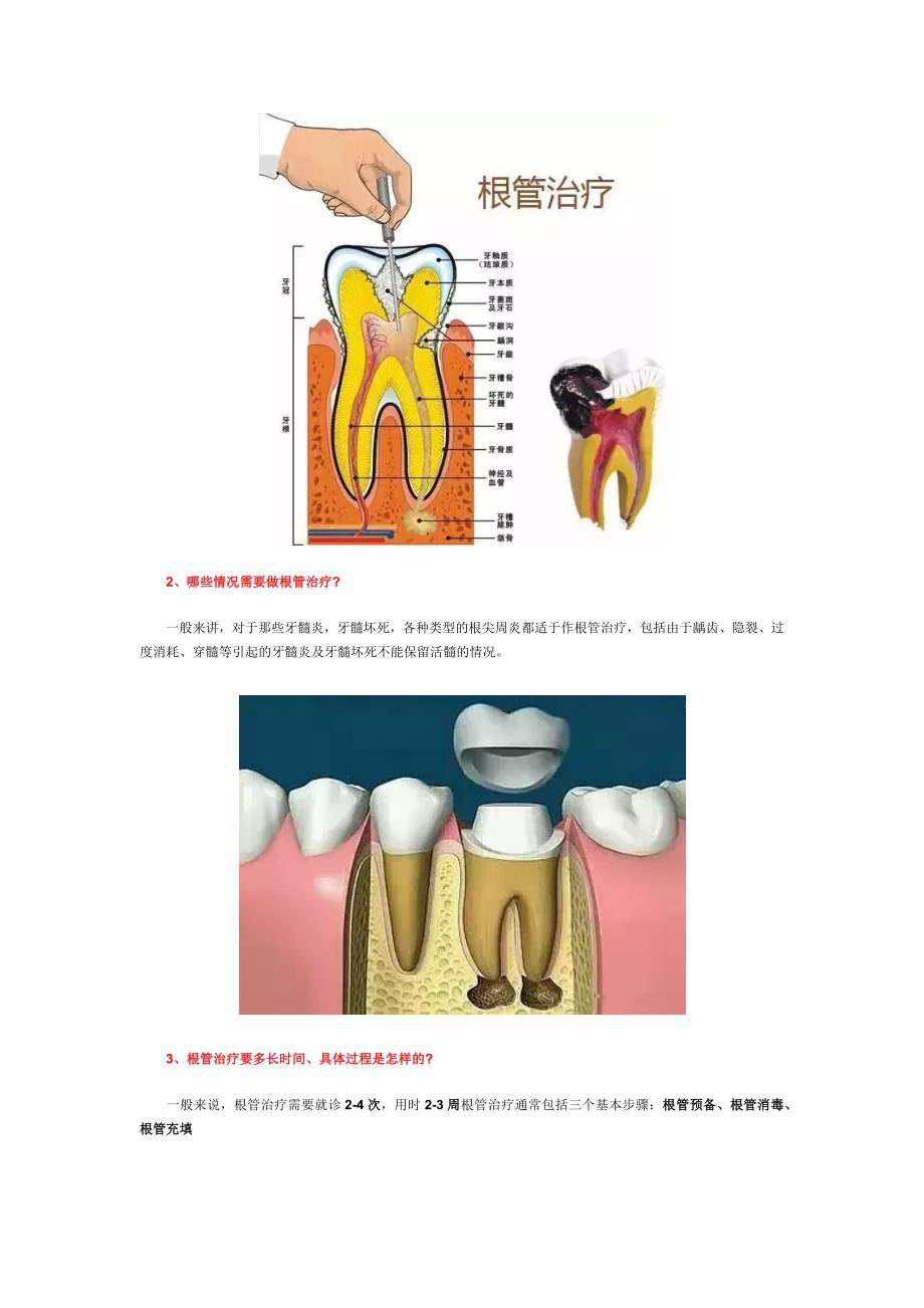 根管治疗是不是就是我们常说的抽牙神经？_第2页