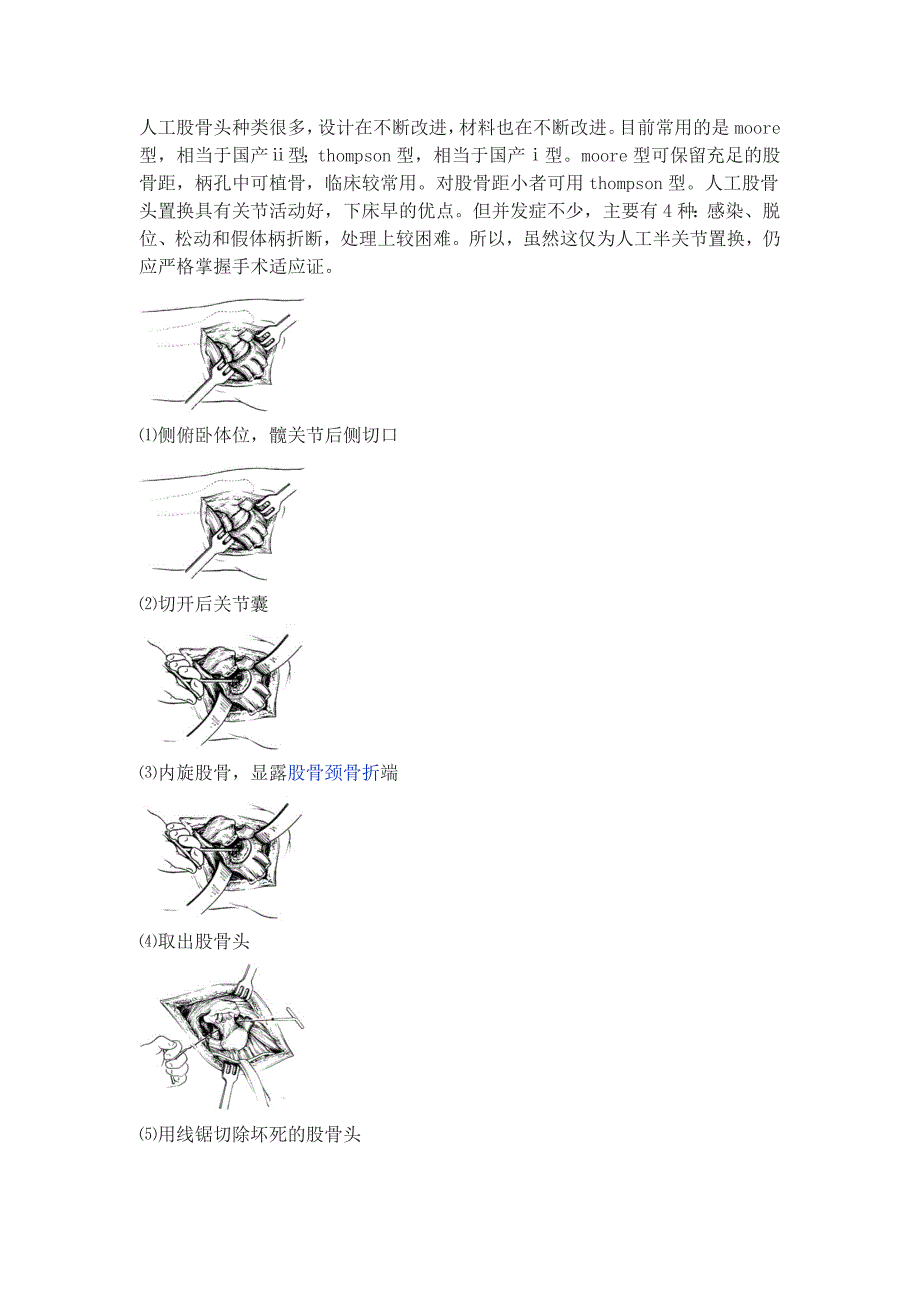 人工股骨头置换术_第1页